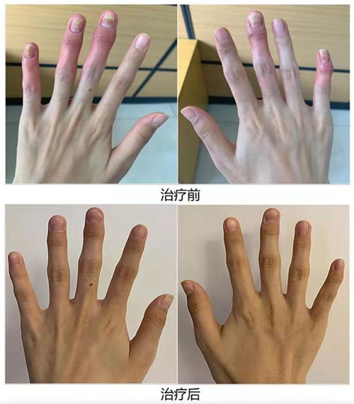 银屑病特效新药,银屑病关节炎专用药