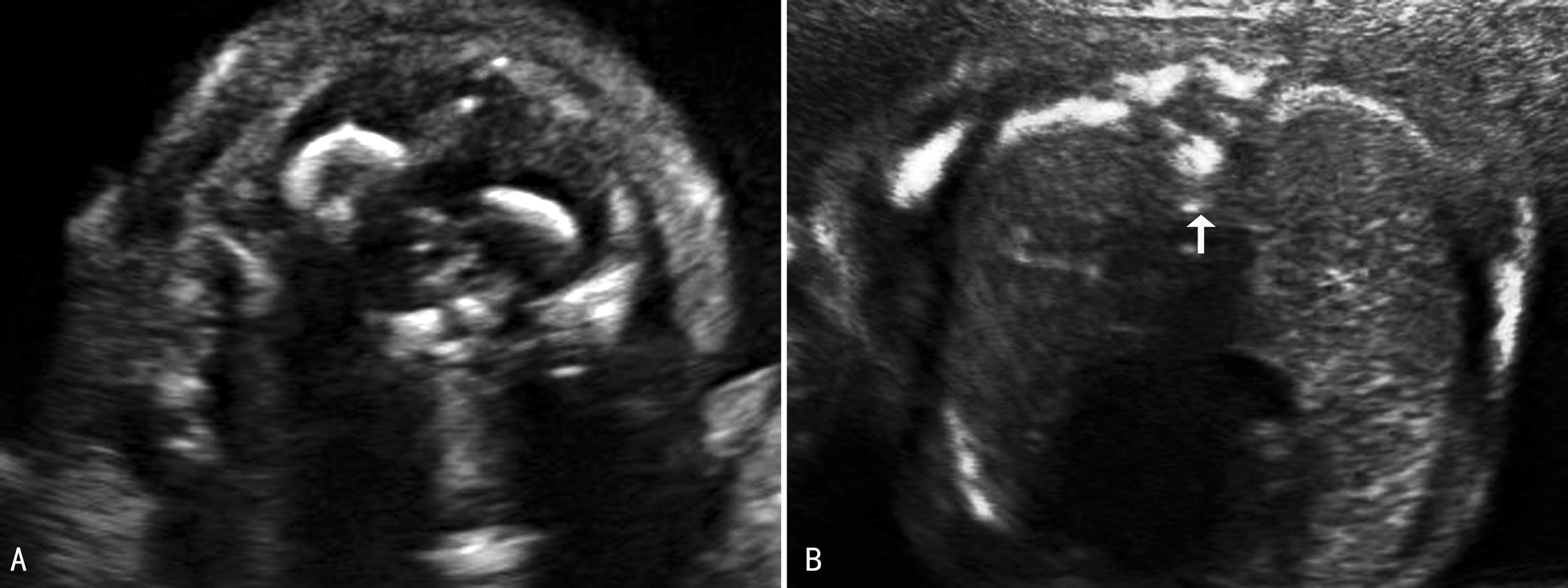 胎儿神经系统发育异常的超声表现,胎儿中枢神经系统超声检查视频