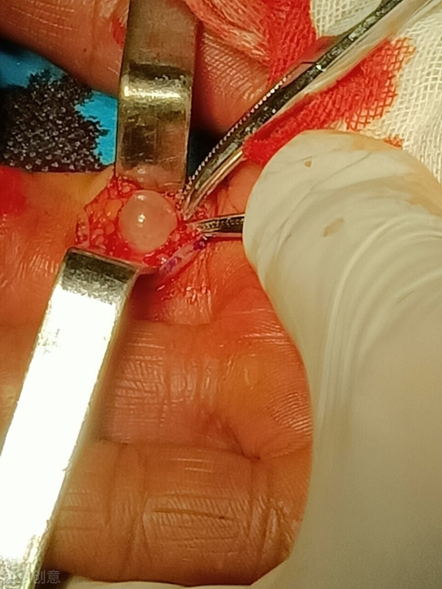 腱鞘囊肿开刀会留多大的疤,手腕腱鞘囊肿开刀的流程