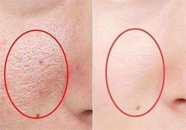 毛孔粗大皮肤粗糙怎么办,男生毛孔粗大毛孔粗糙怎么办