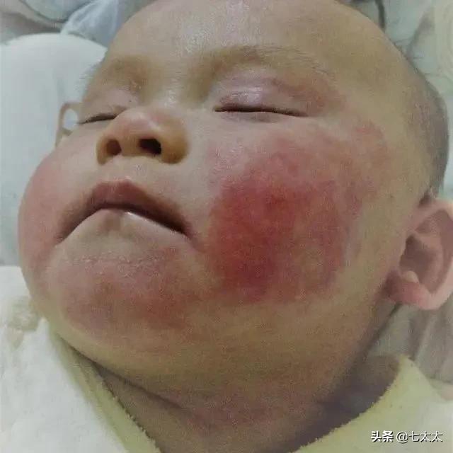 以「湿疹」之名的智商税,除了「大头娃娃」还有什么?