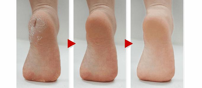 汗脚容易干裂吗,汗脚突然变干脚裂口什么原因