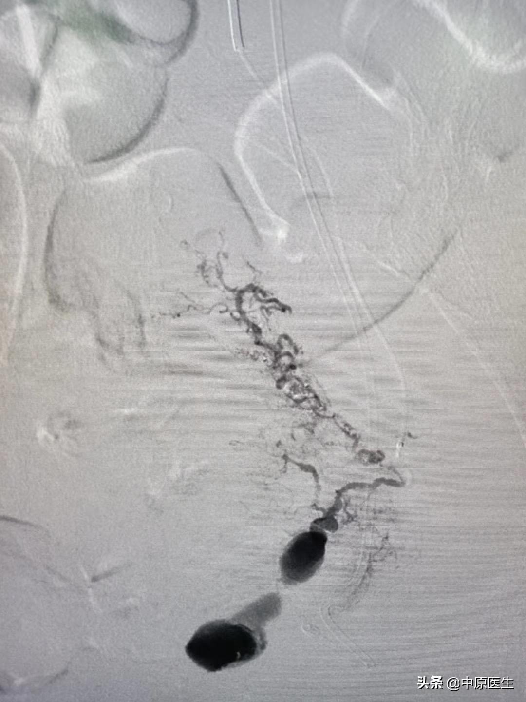 鎴戝湪鏂板啝鐤儏涓殑缁忓巻,鍦ㄦ柊鍐犵柅鎯呮劅鏌撲笅鐨勬垜