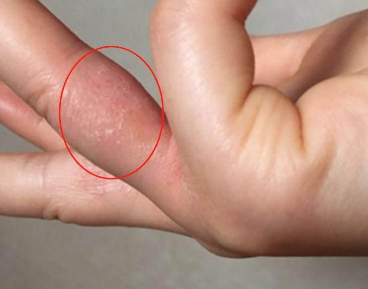 脚底板和脚趾之间长了个水泡很痒,手指缝脚趾缝有小疙瘩痒