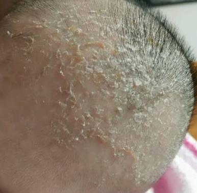 宝宝头垢正确清理方法吴医生,初生婴儿头上脏怎么办