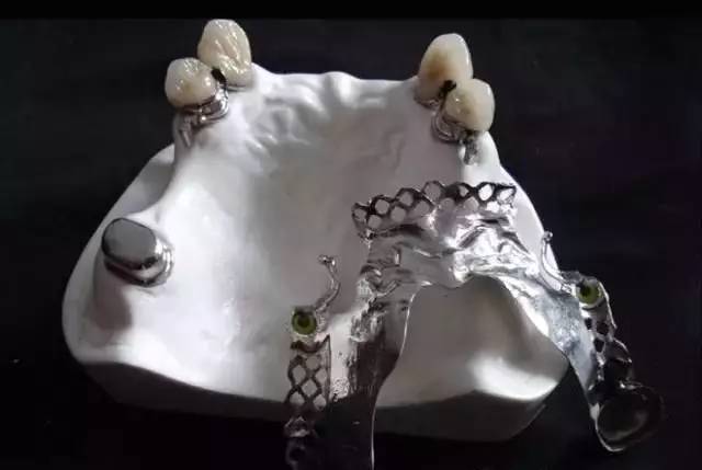 烤瓷牙的危害与副作用,全烤瓷牙有什么风险和后遗症