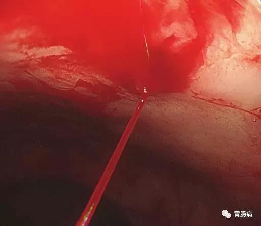 消化道出血的内镜治疗,消化道出血的内镜下治疗