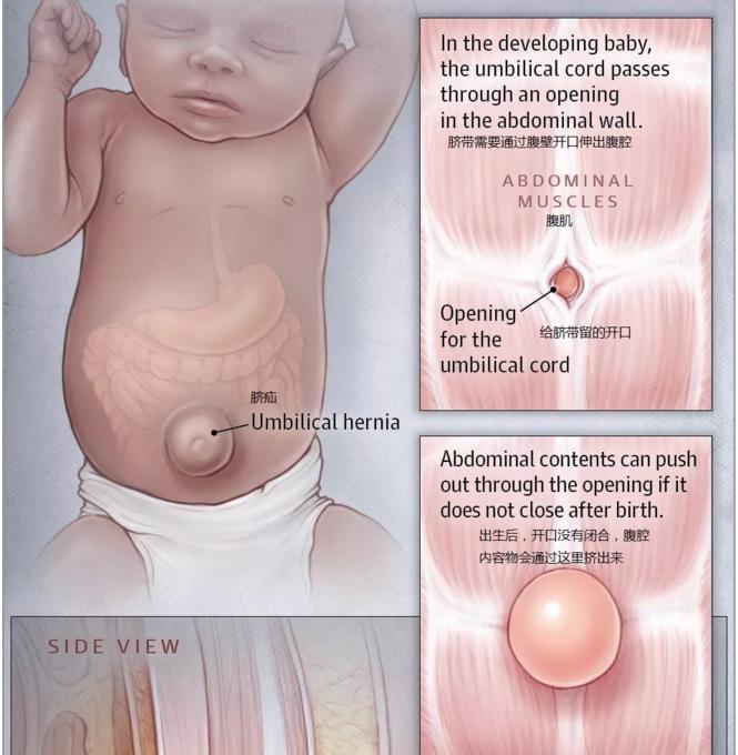 宝宝肚脐下面鼓个包,宝宝肚脐眼鼓了个包