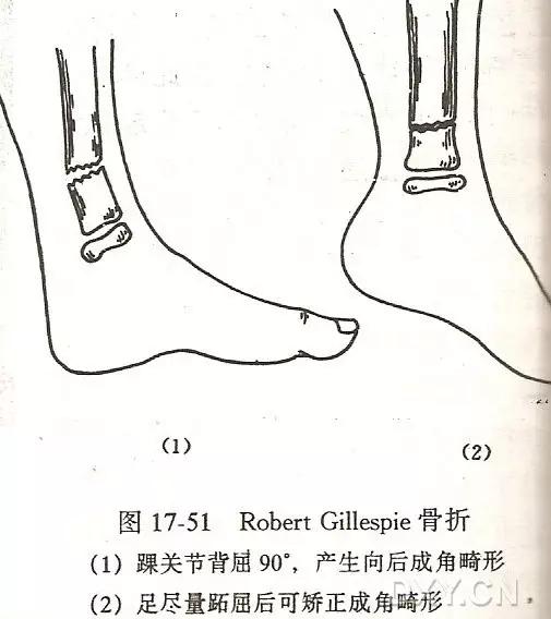 特殊骨折类型,特殊骨折体征