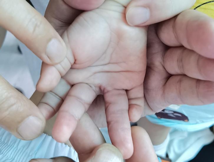 手指植皮后多久可以分指,做并指分指手术复杂吗需要植皮吗