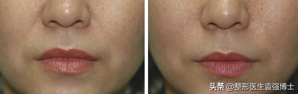 这3种方法解决法令纹效果很惊艳,这3个方法帮你去除法令纹