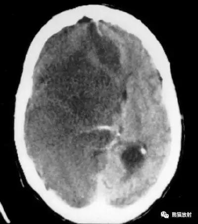 各部位脑梗死ct影像讲解,脑梗死ct影像最简单的是什么表现