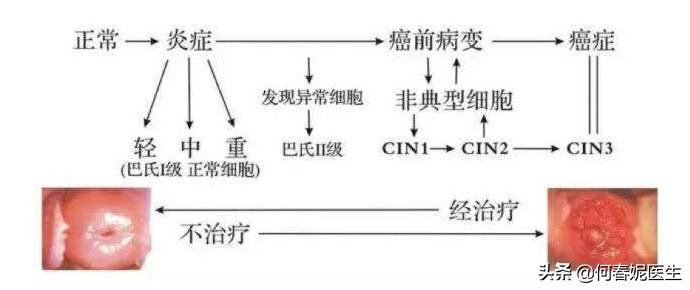 宫颈癌癌前病变无需治疗，一年内可以自动痊愈是真的吗？