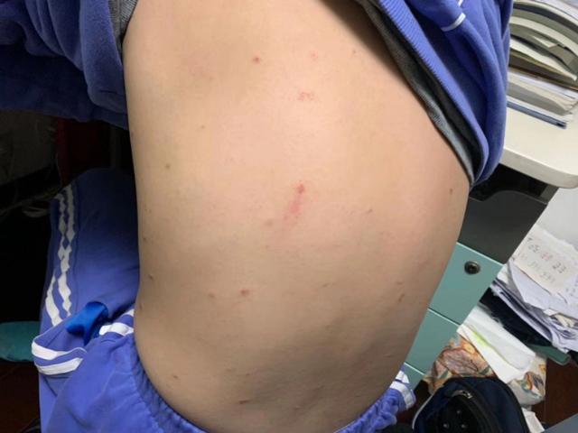 中医治疗皮肤痒的最好方法,中医治疗皮肤纤维瘤