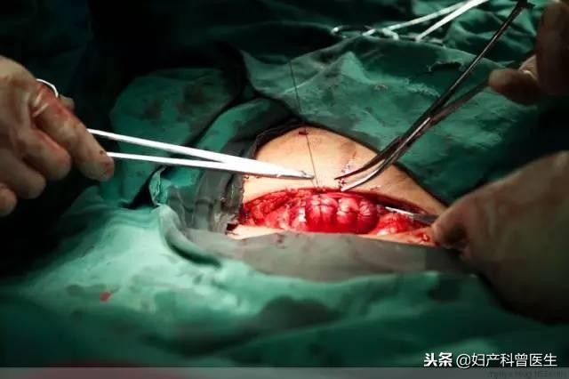 揭开产房神秘面纱,原来剖腹产有多可怕