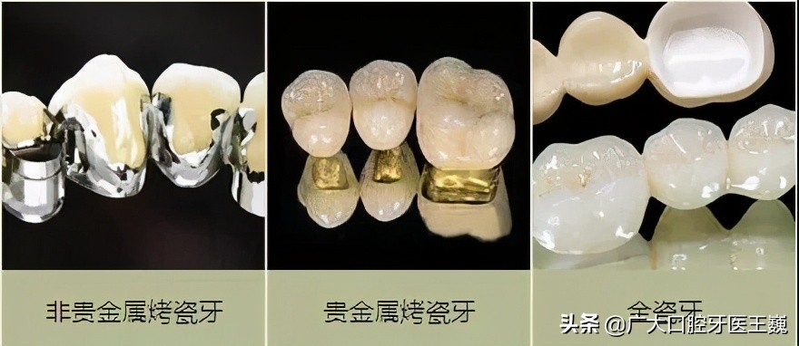 全瓷牙和烤瓷牙有什么区别哪个好,烤瓷牙和全瓷牙有什么区别怎么选