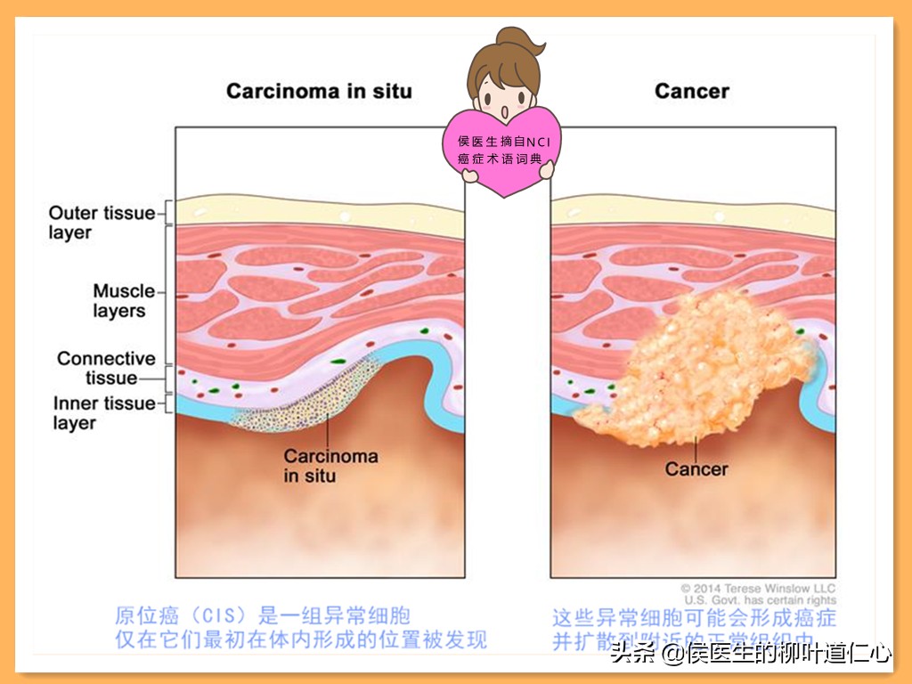 肺结节0.8厘米需手术吗,肺结节0期能治好吗