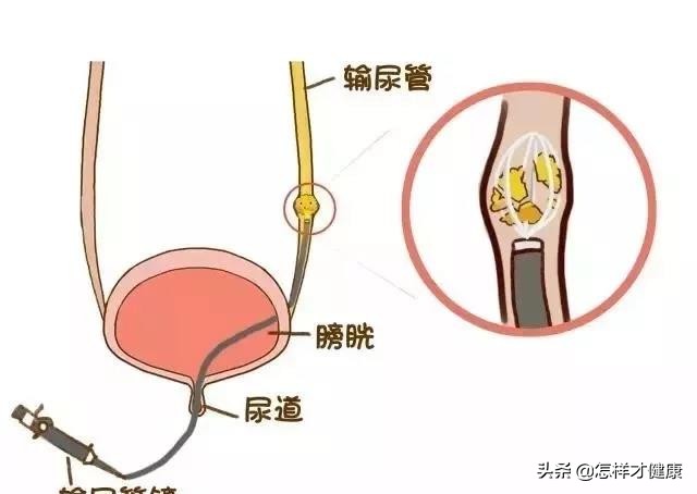 尿路结石疼痛一招搞定是真的吗,尿路结石疼痛怎么止痛最快