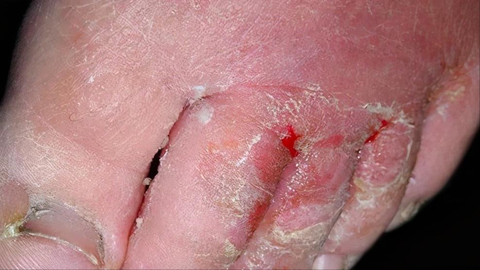 脚上干裂居然是真菌惹的祸