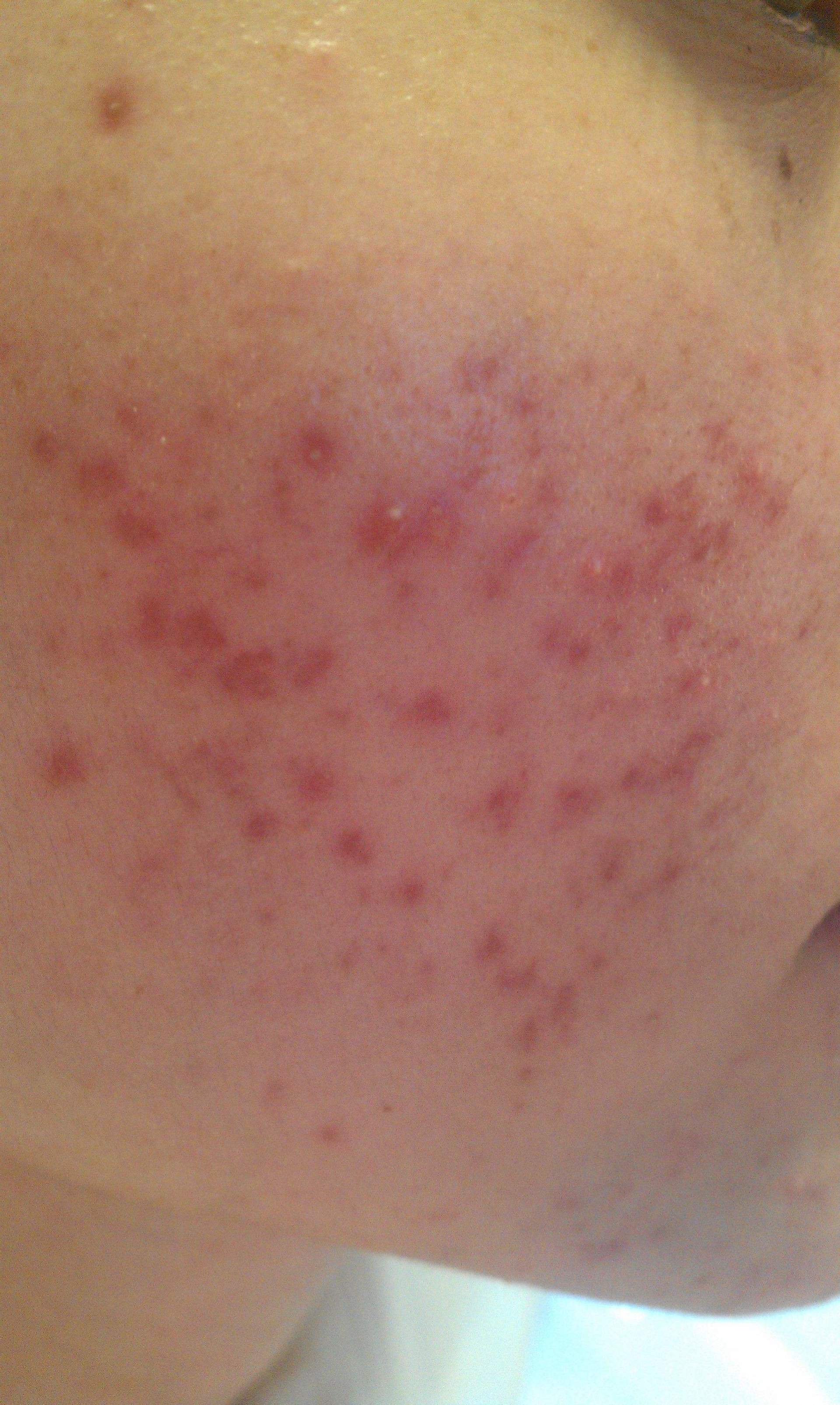 痘印痘坑真正祛除的方法,痘印和痘痘哪个容易消除