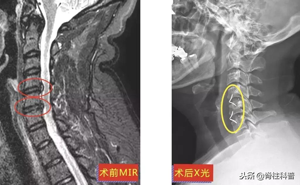 脊髓型颈椎病急刹车,严重颈椎病早期的10大症状