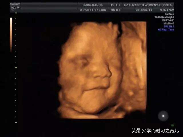 四维检查是好的但生下宝宝脚内翻,四维彩超通过后胎儿还会畸形吗