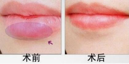 唇部美学图解,唇部美容的方法