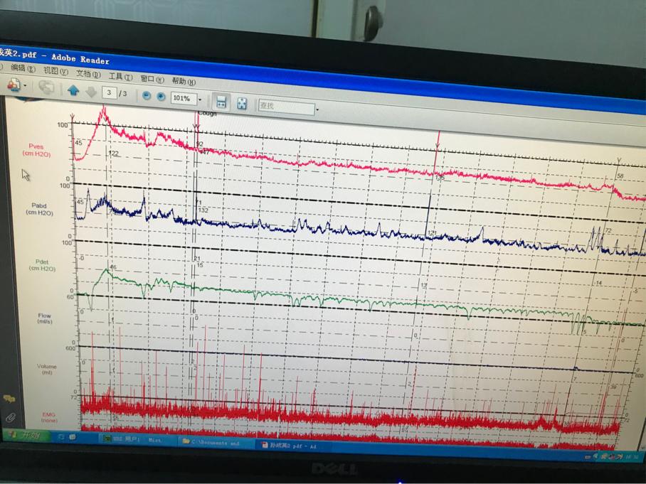 57岁妇女尿频尿急是咋回事啊,老人膀胱尿频