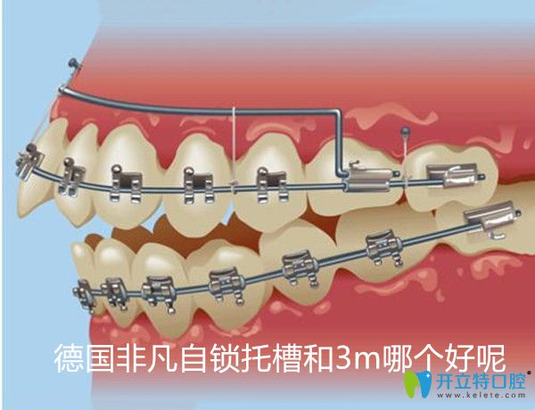 德国飞凡自锁托槽和国产区别,自锁金属牙套品牌有区别吗