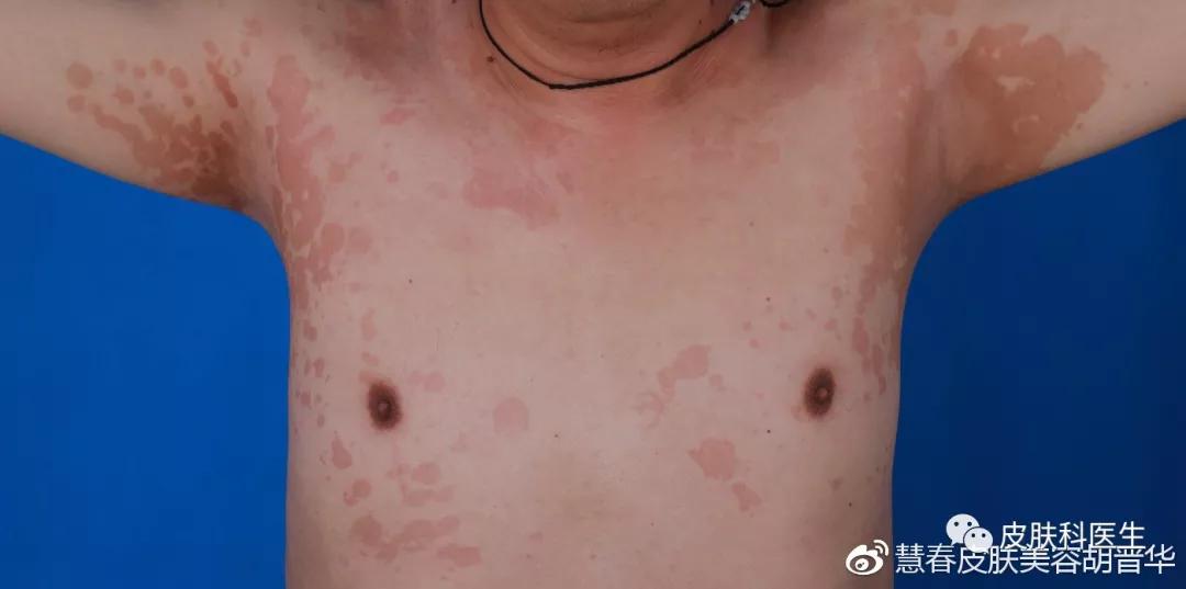 是湿疹或癣医生一眼就能辨出来吗,是不是体癣怎么检查