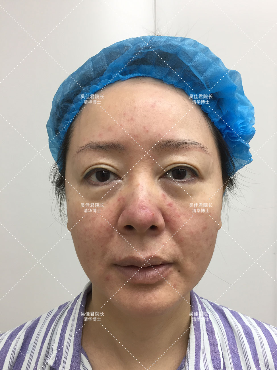 54岁姐姐分享大拉皮术后恢复历程,48岁做拉皮手术的真实经历