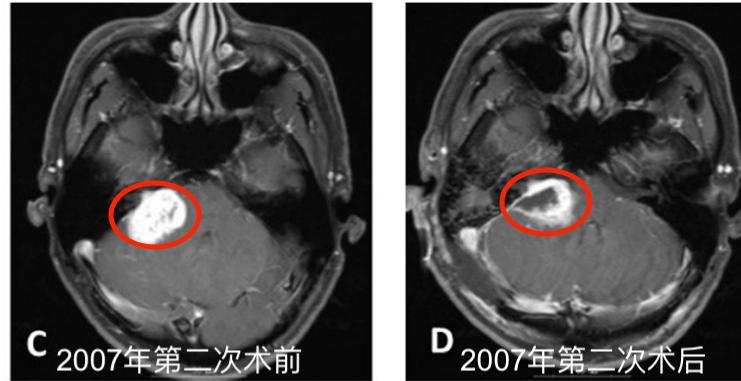 听神经瘤复发做二次手术,听神经瘤复发能要命吗