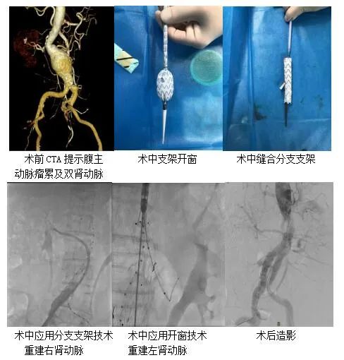 主动脉瘤患者的微创“拆弹”专家——山东大学齐鲁医院（青岛）孙念峰教授血管外科专业团队