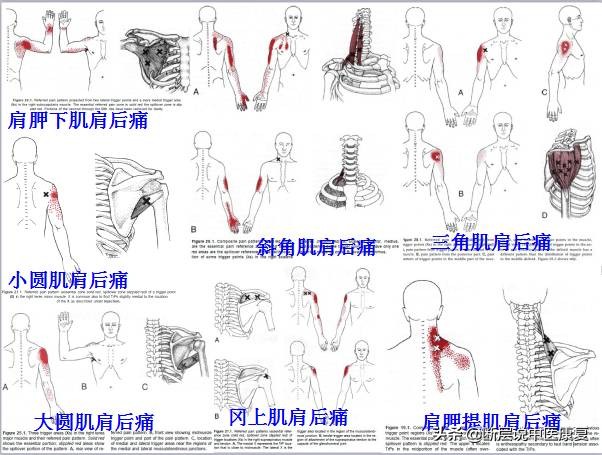 激痛点挂图,激痛点疗法笔记