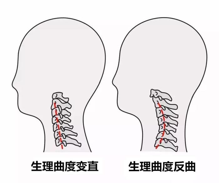 颈椎生理曲度消失后如何恢复,颈椎腰椎生理曲度消失是什么意思