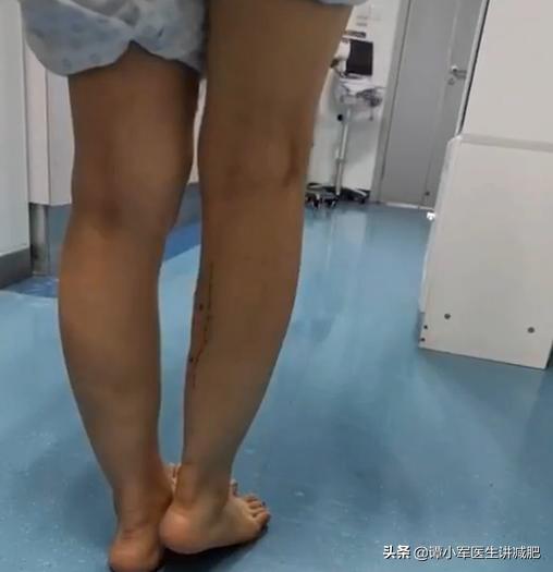 溶脂瘦腿和吸脂瘦腿的区别,吸脂瘦腿有什么危害