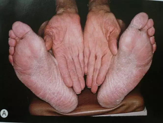 脚被真菌感染水疱型足癣多久才好,真菌足癣可以彻底解决吗