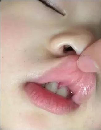 换牙门牙缝隙多大算正常,小孩换牙的门牙缝隙大图片