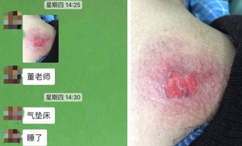 压疮敷料的选择及使用,褥疮敷料的正确使用方法