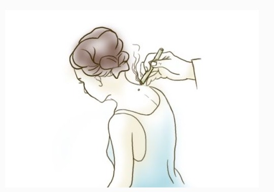 风热感冒咳嗽艾灸哪里效果最好,风热感冒头疼艾灸哪个穴位