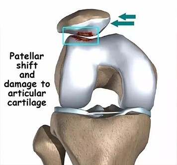 髌骨脱位复发性与习惯性区别,儿童髌骨脱位原因是什么