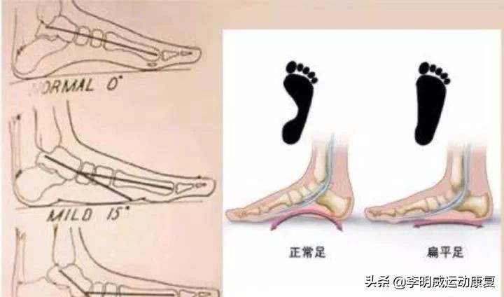 如何矫正足外翻四岁半,怎样矫正足外翻视频