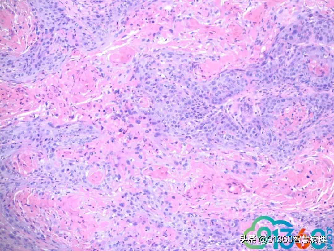 宫颈病理检查与tct检查的区别,病理诊断宫颈活检鳞癌