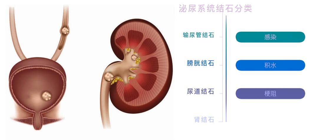 得了尿道结石怎么办,得了泌尿系统结石怎么办
