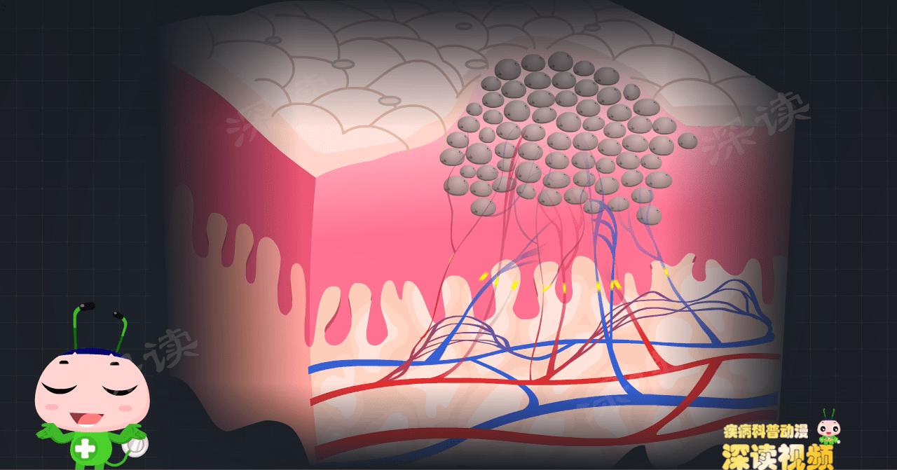 明明没出轨，为啥染上尖锐湿疣？*处私**咋就长出“菜花”了？