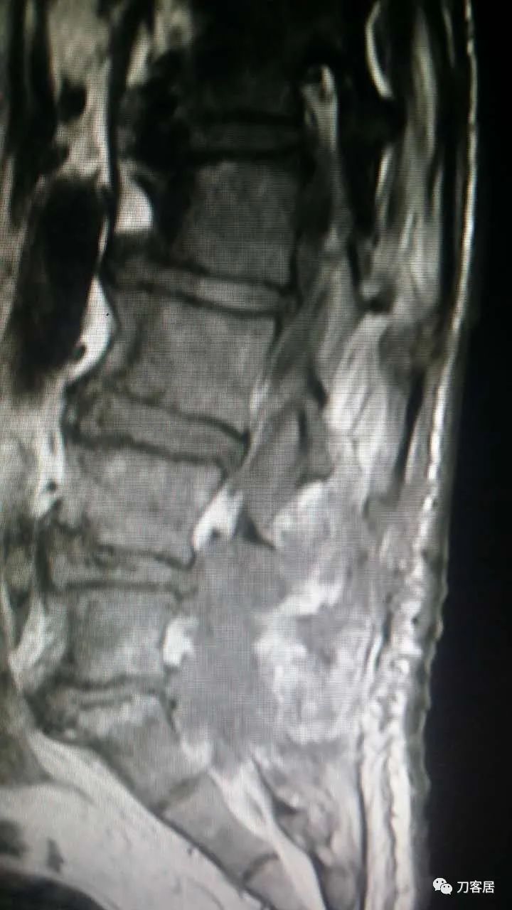 腰椎手术切掉棘突,腰突微创后出血肿