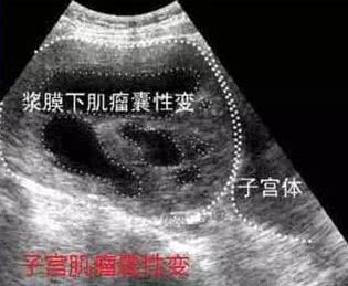 子宫肌瘤变性是癌吗,b超查出子宫肌瘤要做活检吗