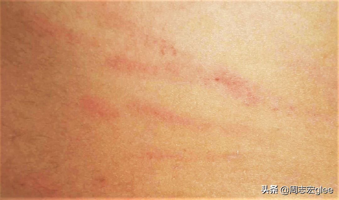 蚊虫叮咬一直痒怎样治,蚊虫叮咬越挠越痒怎么办