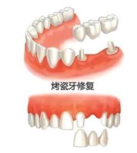 缺牙不想种植也不想镶,缺牙时间长了还能镶吗