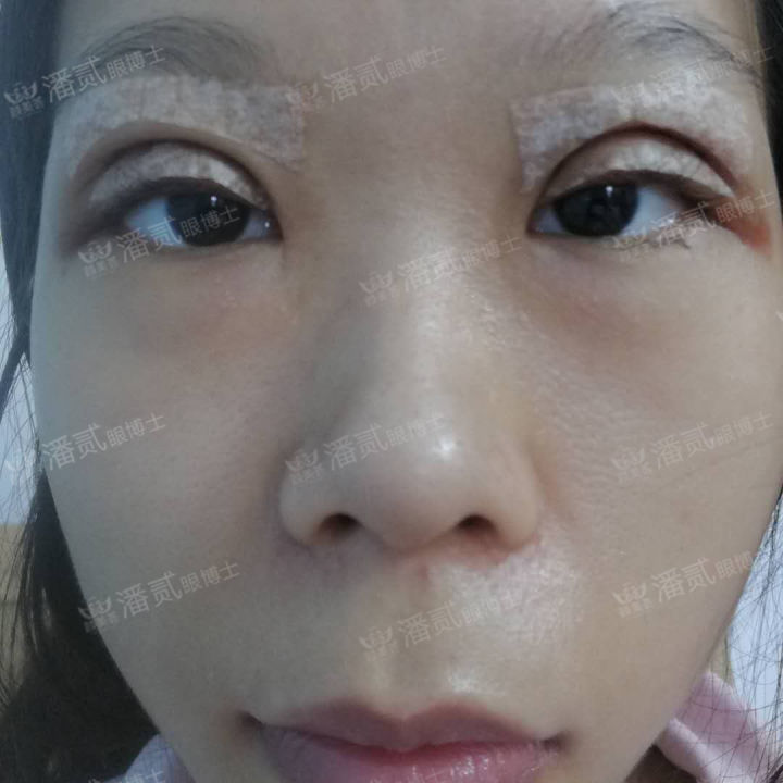 原来双眼皮不好看有必要继续割吗,割双眼皮是不是越修复越难看